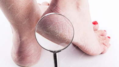  What Causes Cracked Heels? Common Reasons, Prevention Tips & Professional Treatments